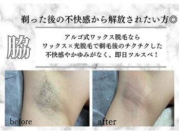 アルゴ 熊本八代店(ALGO)/【脇】不快感や痒みからの解放☆