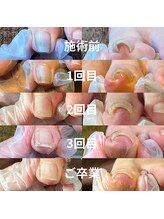 トトメス(thutmose)/巻き爪ケア