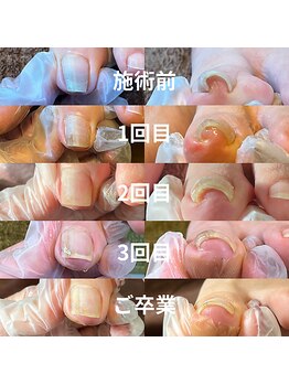 トトメス(thutmose)/巻き爪ケア