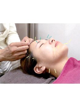 鍼灸施術を受けたい