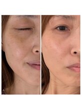 フォーティチュード(FORTITUDE)/光６回施術と自宅ケアで透明感♪