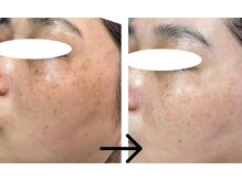 コトハ(cottha)/シミケア