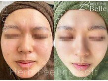 ベル 代々木店(Belle)/ニキビケア施術例