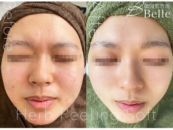 ベル 代々木店(Belle)/ニキビケア施術例