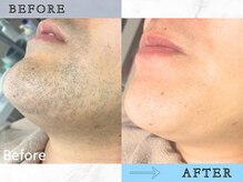 ラッシュ(RUSH)/たった4ヵ月でヒゲ剃りいらずに