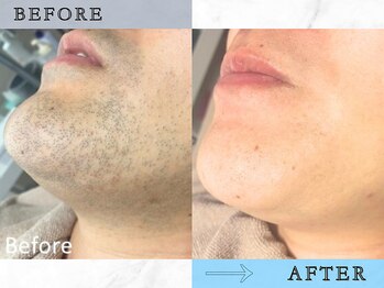 ラッシュ(RUSH)/たった4ヵ月でヒゲ剃りいらずに