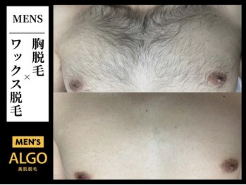 アルゴ 小倉守恒店(ALGO)/胸ワックス脱毛