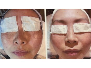 ソワージュ エレガンス Soiege Eleganceの写真/≪光フェイシャルIPL》日焼けによるシミ、しわ改善ケア。肌色も明るくリフティングや小顔にも◎