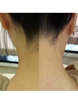 スイ 四条烏丸(SUI)/〇うなじシェービング