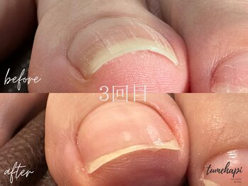 ツメハピ(tumehapi)/巻き爪ケア３回目