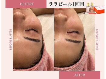 ラシック(La chic)/毛穴洗浄/ララピール大阪心斎橋