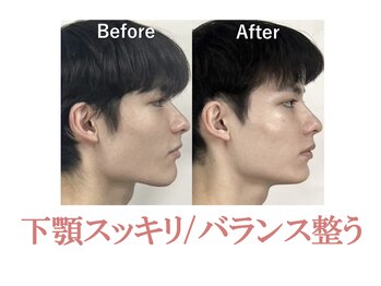 ラプリ 新宿店(Raplit)/隆鼻+輪郭矯正40分10回