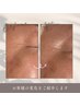 【 美肌再誕 】本気のエイジングケア★”ヒト幹細胞美容液２ml導入”￥22000