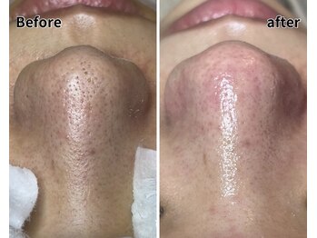 エヌエクラ(N.eclat.)/鼻