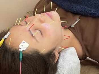 リンパハーブ鍼灸院さくら/鏡よ鏡美容鍼の様子