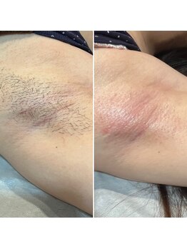 トリプルワン(111)/キッズボディWAX脱毛