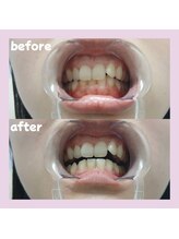 パレ 大阪十三店(Palet)/1回照射後のbefore/after