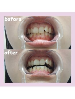 パレ 大阪十三店(Palet)/1回照射後のbefore/after