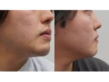 リムーブ(Re:move)/【髭脱毛Before→After】