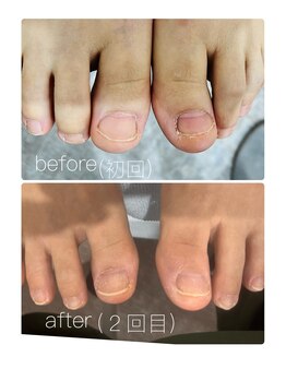 ビーユー(BeYou)/フット深爪矯正