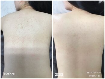 ラウレア(LAULEA)/ハーブピーリングBefore/after