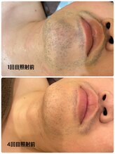 ダリオムズ 西宮北口(DAHLI HOMMES)/☆メンズヒゲ脱毛☆