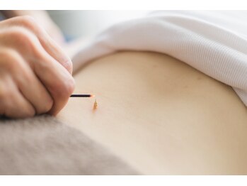 アキュベース鍼灸マッサージ院(AcuBase鍼灸マッサージ院)/腰へのお灸