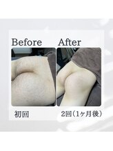 ティグレ 岡山店(TIGRE)/メンズVIOお尻セット