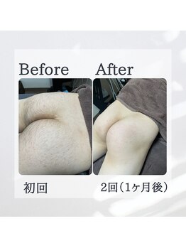 ティグレ 岡山店(TIGRE)/メンズVIOお尻セット