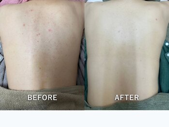 サロンドジェシカ(salon de Jessica)/背中洗浄