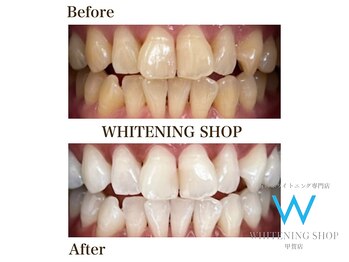 ホワイトニングショップ 甲賀店/Before&After『ホワイトニング』