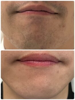 ディーバッカス(D Bacchus)/顔脱毛ビフォーアフター