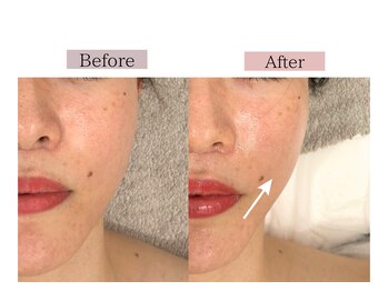 フロリール アザブジュウバン(FlorirAzabujuban)/小顔/リフト/たるみケア