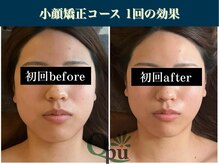 キュープ 表参道店(Qpu)/ 小顔矯正回コース1回の変化