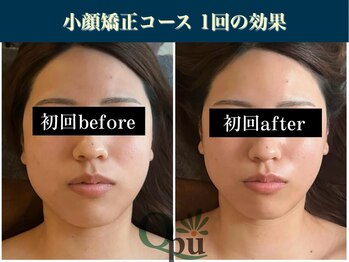 キュープ 表参道店(Qpu)/ 小顔矯正回コース1回の変化