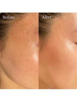 ゆりの花/ハーブピーリング