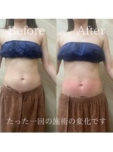 介正鍼灸整骨院 整体院 エフコープ大野城店/痩身エステ／ビフォーアフター