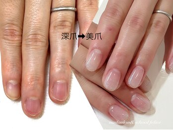 フェリーチェ(nail salon&school felice)の写真/【ケアコンテスト全国6位のスタッフ在籍】見惚れるほどの美爪へ♪巻爪・深爪などの爪にお悩みがある方も◎