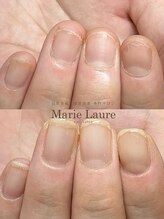 マリーロール 梅田店(Marie Laure)/自爪育成/深爪矯正/ネイルケア