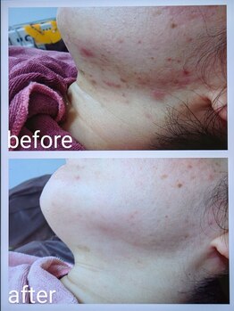 クリニカルエステクリア 梅田店/【赤・黄ニキビケア赤み跡実例】