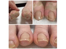 巻き爪UPジェルおすすめ！装具を付けず広げていくので違和感なし