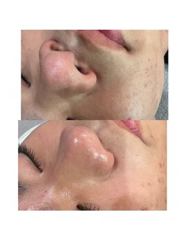 ラローゼ トウキョウ(LA ROSEE TOKYO)/10代の思春期ニキビ集中ケア