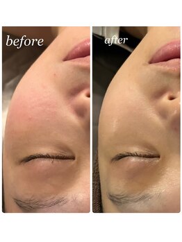 プレジール(Plaisir)/人気No. 1サーマ＋ララピ-ル+LDM