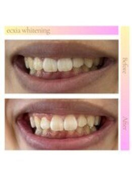 エクシアホワイトニング 長崎店/ホワイトニングビフォーアフター