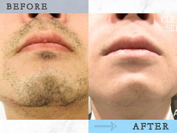 ラッシュ(RUSH)/8回で青ヒゲ卒業!