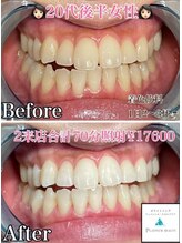 ホワイトニングビューティー 松戸店(Whitening Beauty)/ビフォーアフター