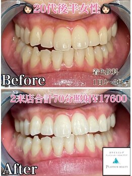 ホワイトニングビューティー 松戸店(Whitening Beauty)/ビフォーアフター