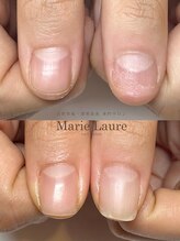 マリーロール 梅田店(Marie Laure)/自爪育成/深爪矯正/ネイルケア