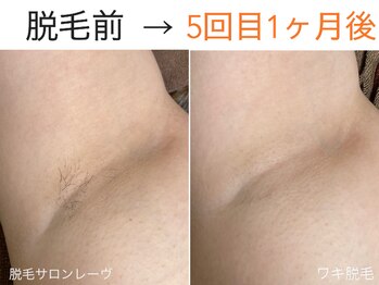 レーヴ/ワキ脱毛の効果☆