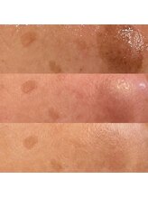 プルメリア(Plumeria)/シミケア経過段階